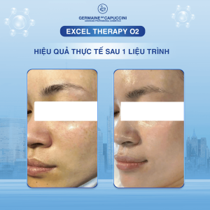 Liệu trình oxy chống ô nhiễm đô thị Thanh lọc và tái tạo da excel therapy o2