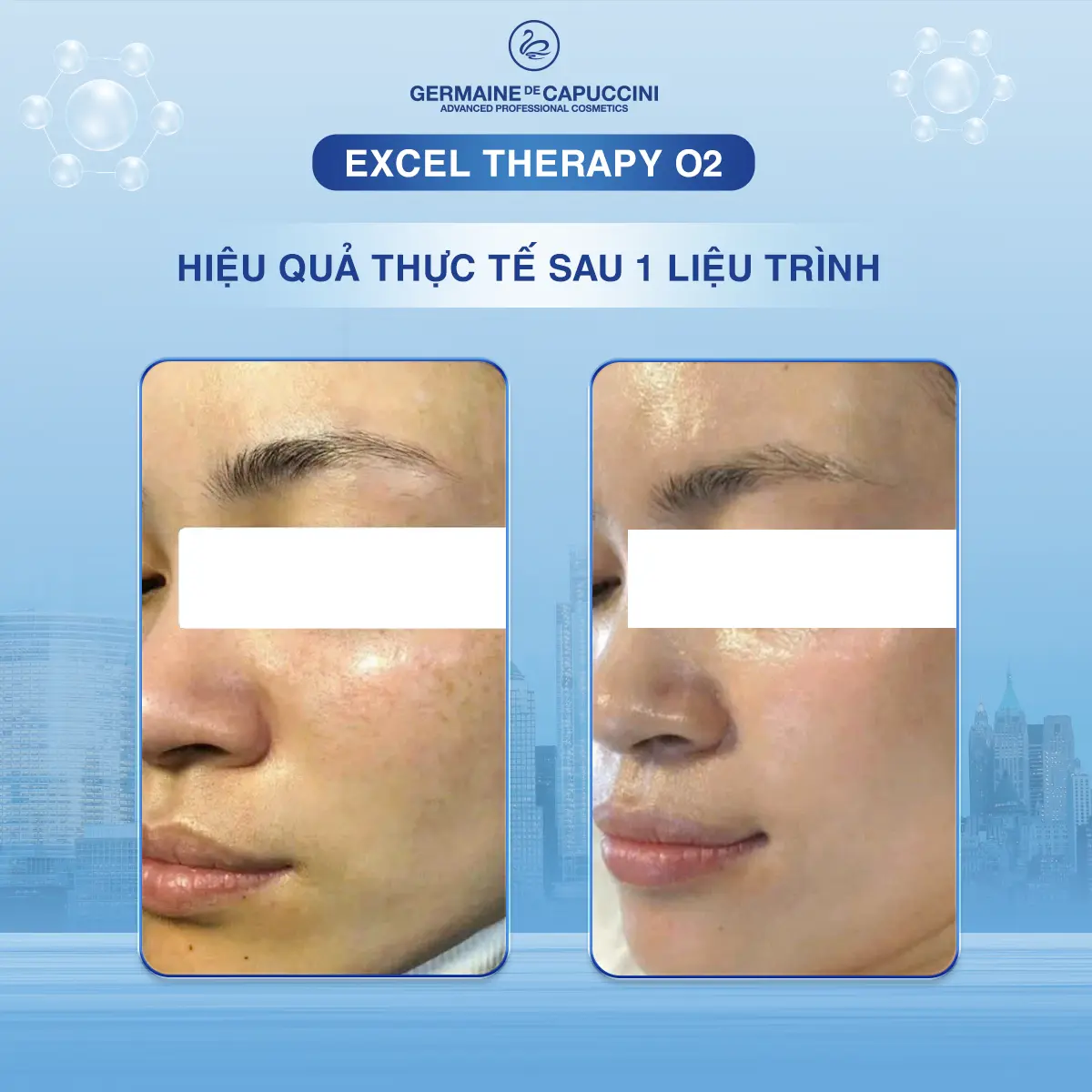 Kết quả thực tế sau một liệu trình Excel Therapy O₂ - hình 1